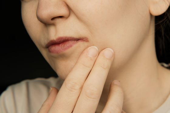 what is cheilitis mouth sores