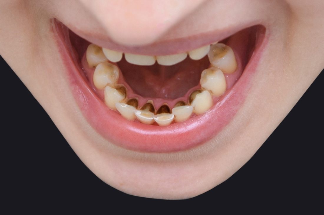 Black plaque spot on teeth