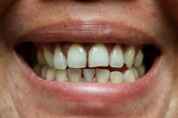 what are brown stains on teeth close up