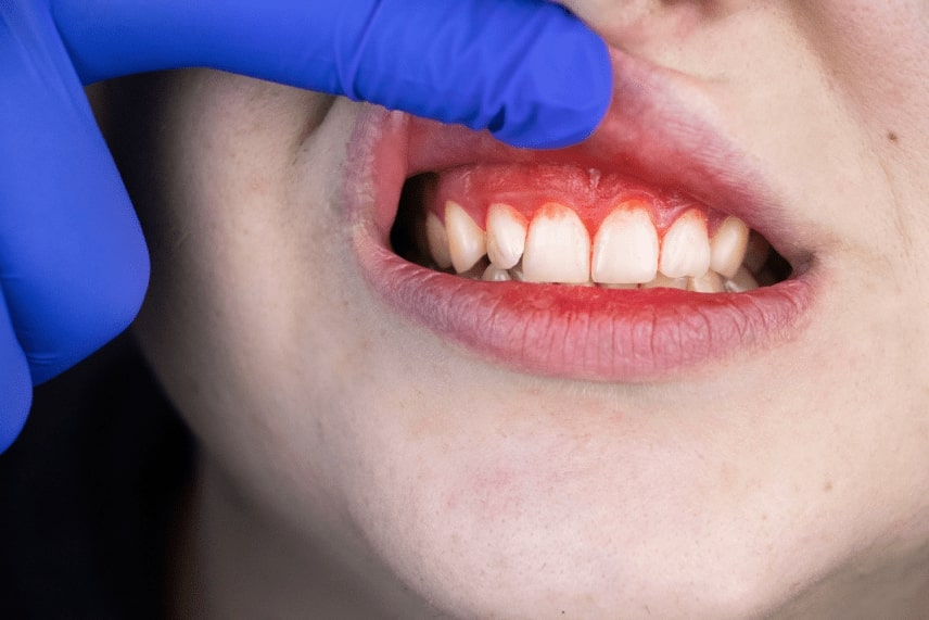 Gum bleeding and inflammation close up of gingivitis