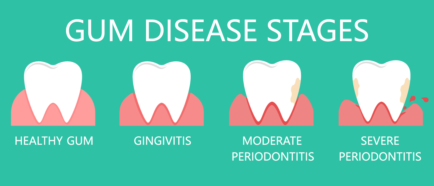 The stages of gum disease, the signs of periodontitis