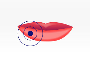 Picture of lips with a target to show where a cold sore may begin.