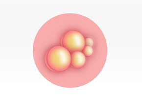 Picture to show the progression of fever blister clusters.