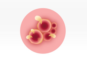 Graphic showing burst fever blisters during the rupture stage of cold sores.