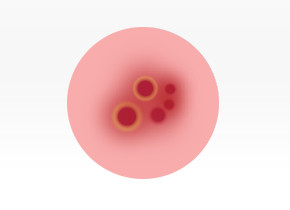 Graphic showcasing cold sore scabbing.