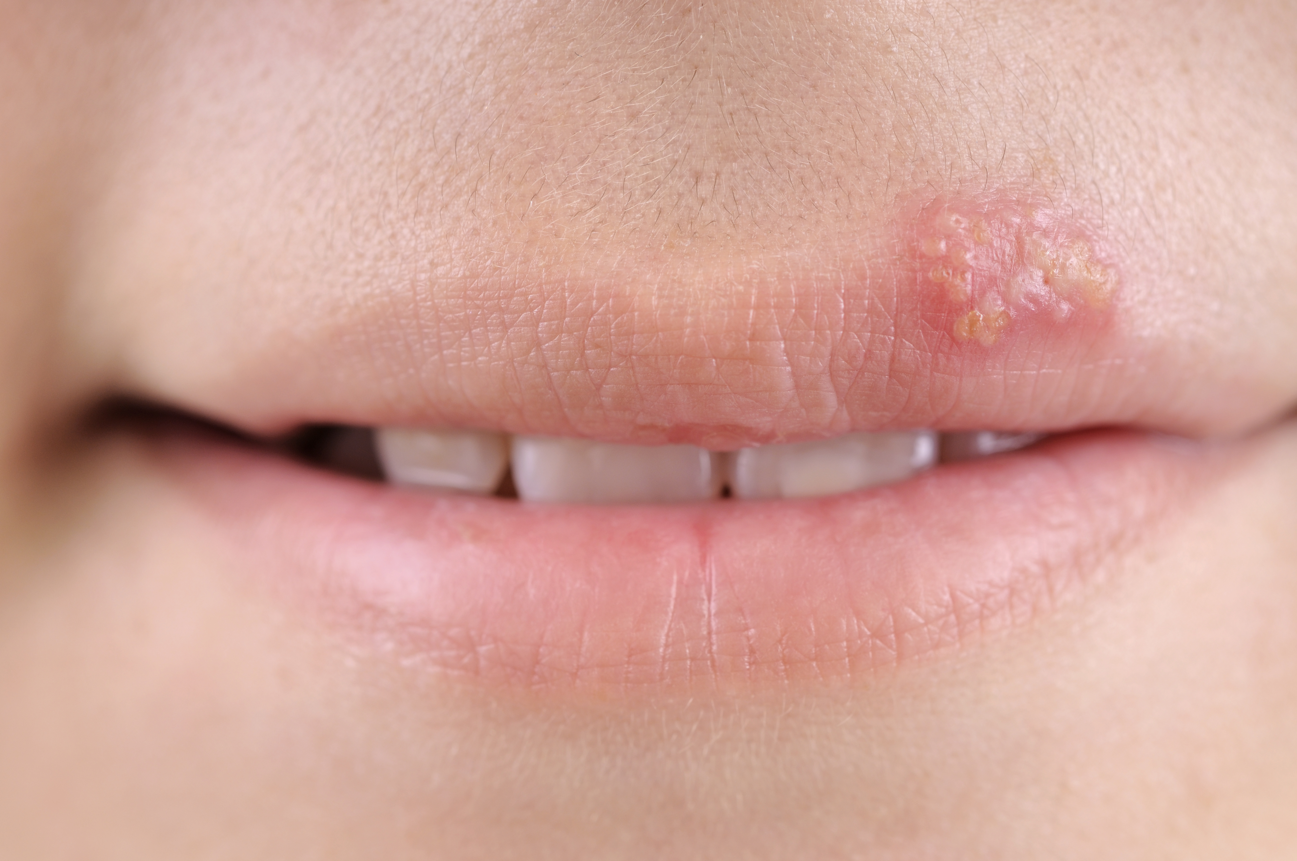 Close-up of a person’s lips during the early and healing stages of a cold sore.